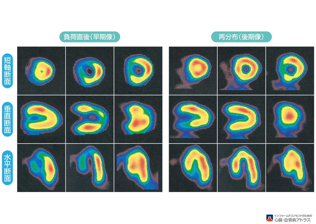 心筋シンチグラフィー検査