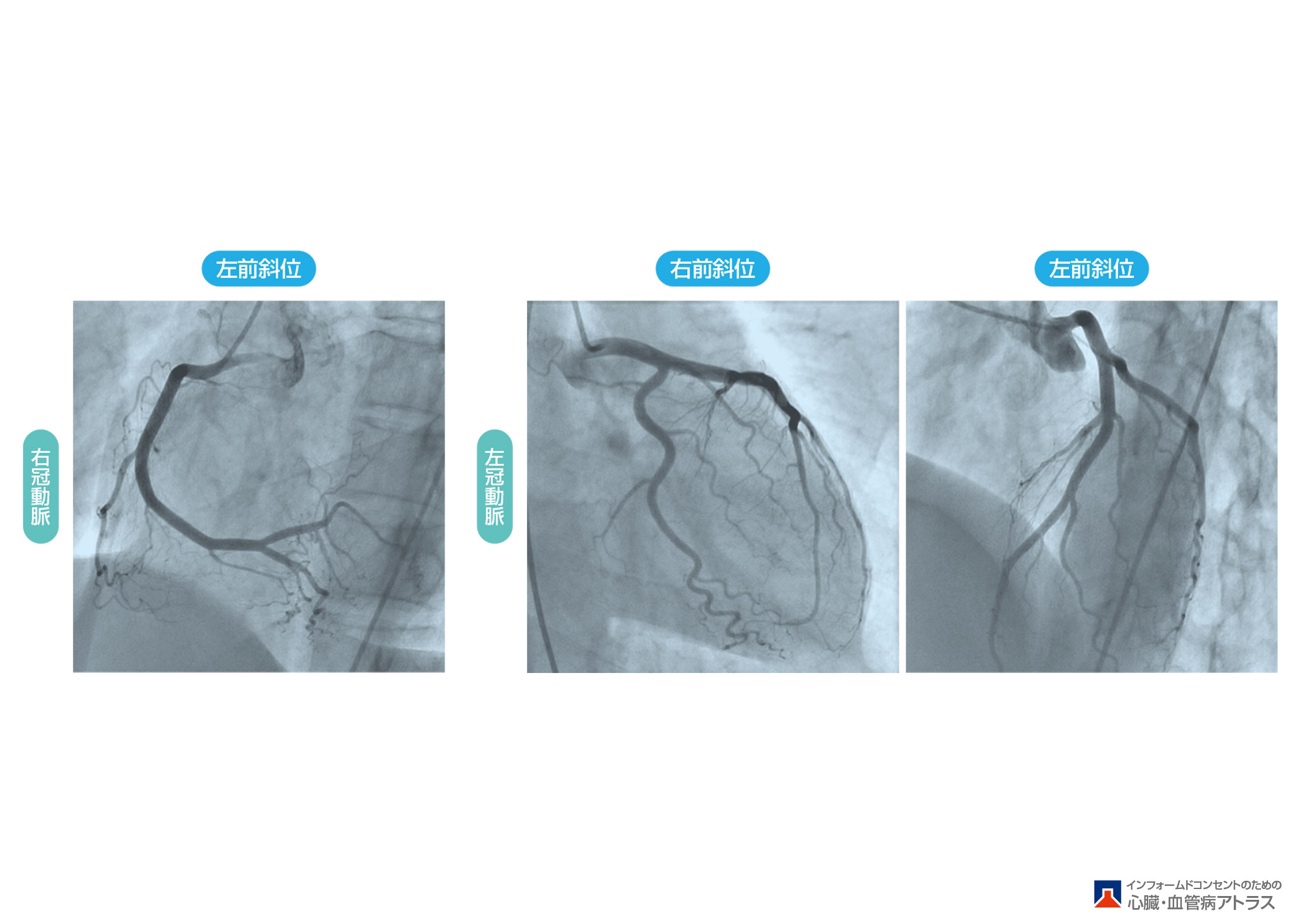 冠動脈カテーテル検査