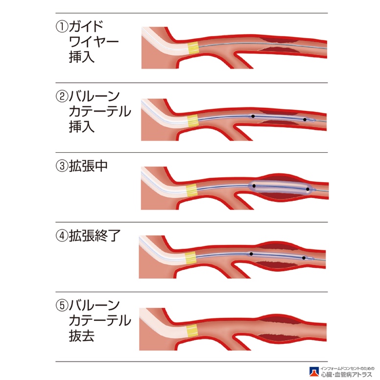 バルーン拡張術