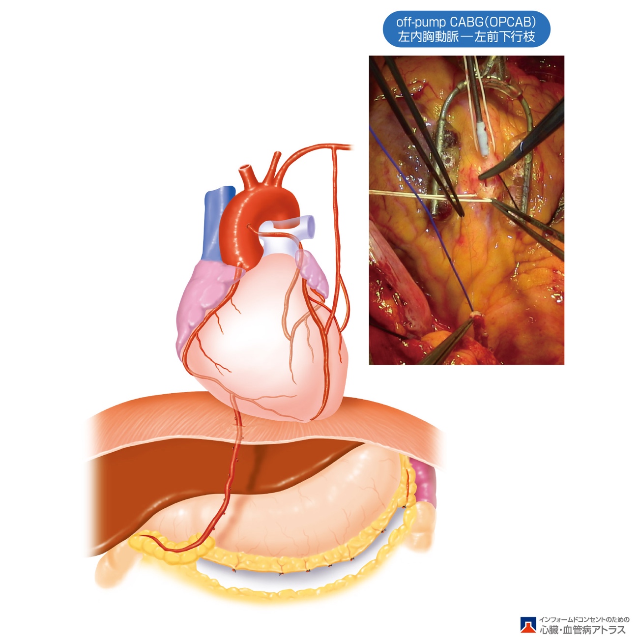 冠動脈バイパス術 (CABG)