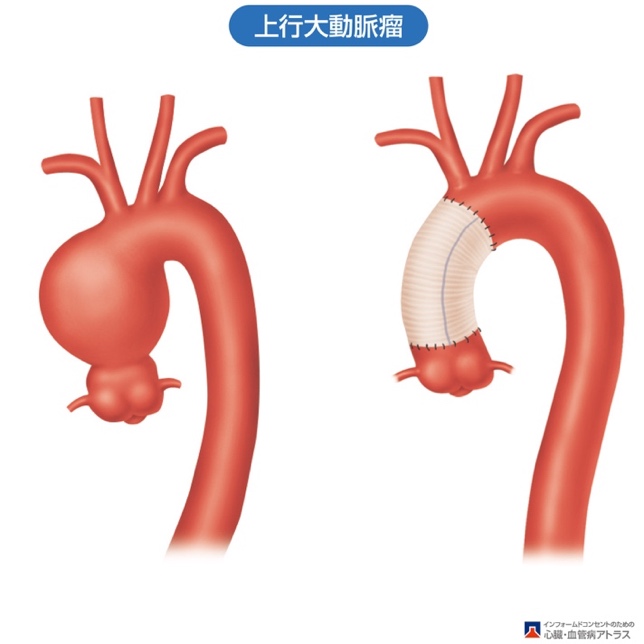 大動脈瘤・大動脈解離