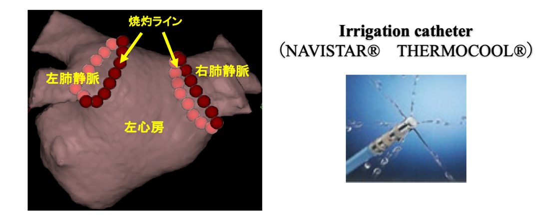 高周波アブレーション (RFCA; radiofrequency catheter ablation)