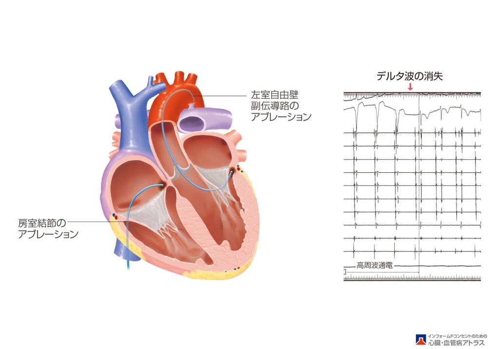 WPW症候群のアブレーション