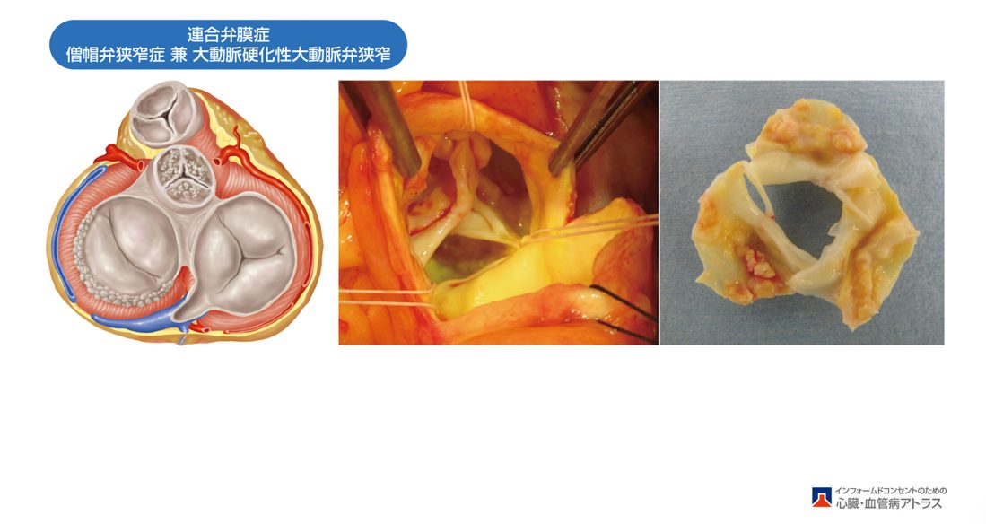 大動脈弁狭窄症 (AS)