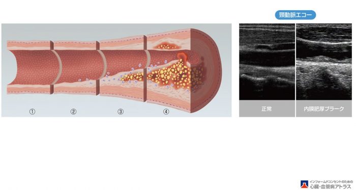 動脈硬化とは