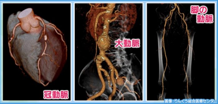 造影CT検査