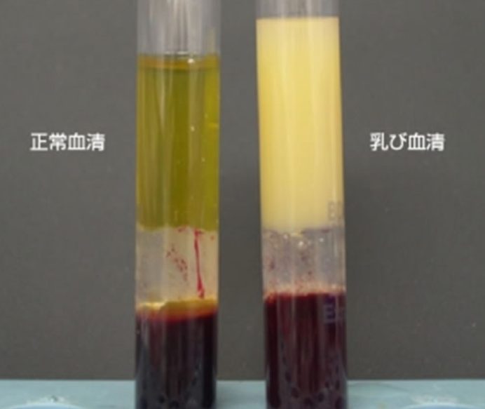 高コレステロール血症 (高脂血症)