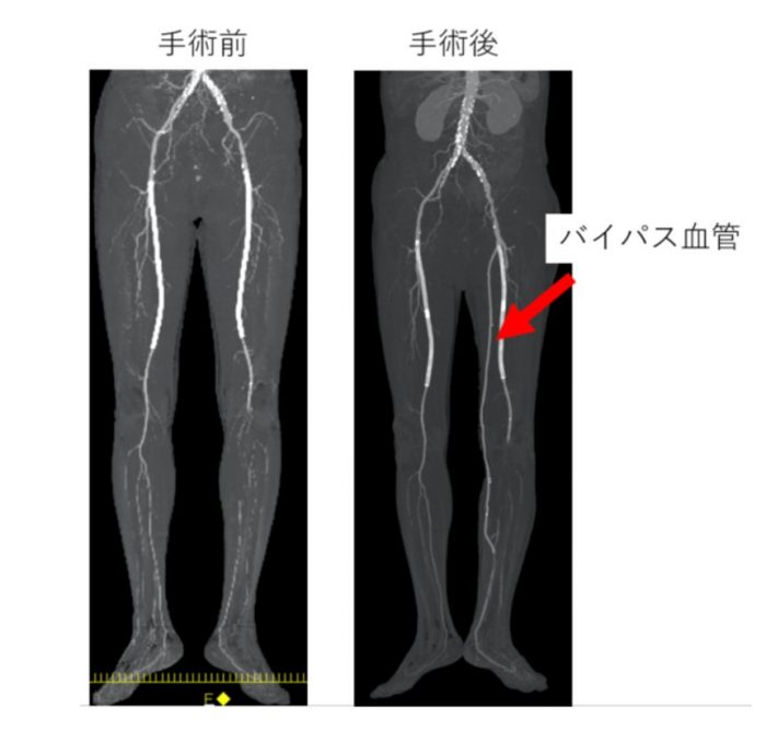 バイパス術